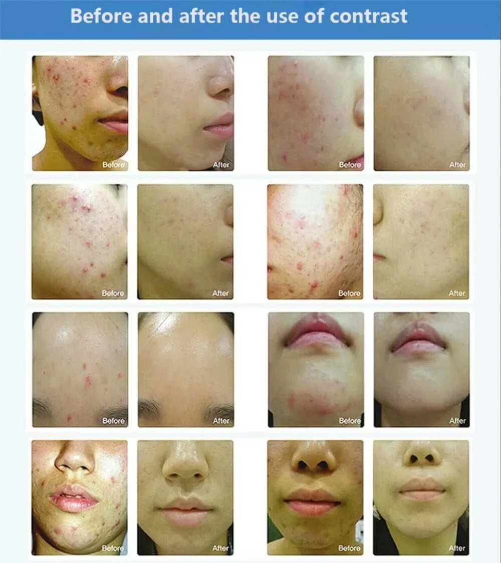 Omega Light LED Therapy original